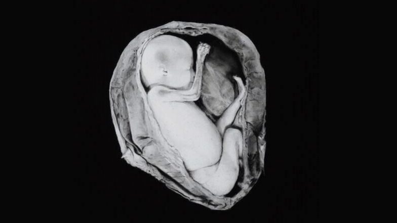 पहली बार मृत महिला के गर्भाशय से हुआ सेहतमंद बच्ची का जन्म