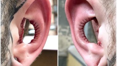 सुनने की क्षमता बढ़ाने के लिए शख्स ने कटा लिए दोनों कान, सर्जरी के बाद अजीब तस्वीरें हुई वायरल