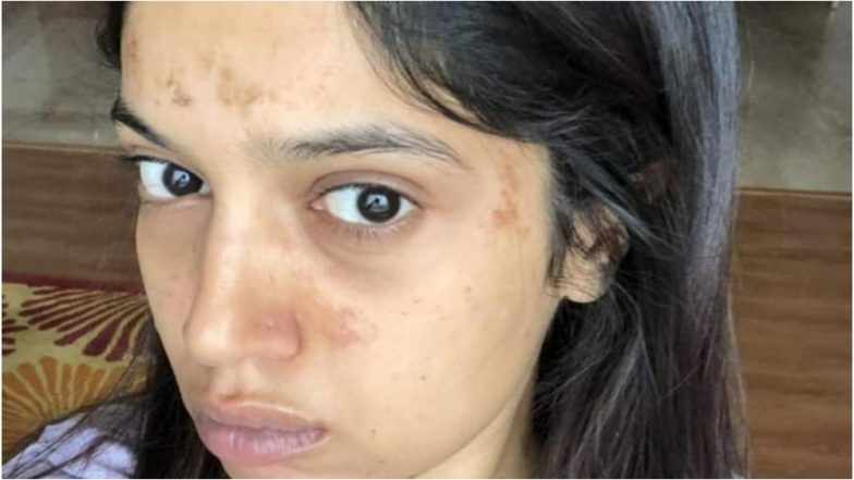 फिल्म 'सांड की आंख' की शूटिंग के दौरान भूमि पेडनेकर के चेहरे पर पड़ गए छाले, वायरल हुई फोटो