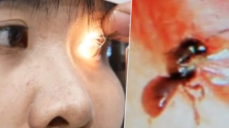 Mucormycosis: ब्लैक फंगस की चपेट में महाराष्ट्र, अब तक 9268 मामले आए सामने, 1,112 मरीजों की मौत