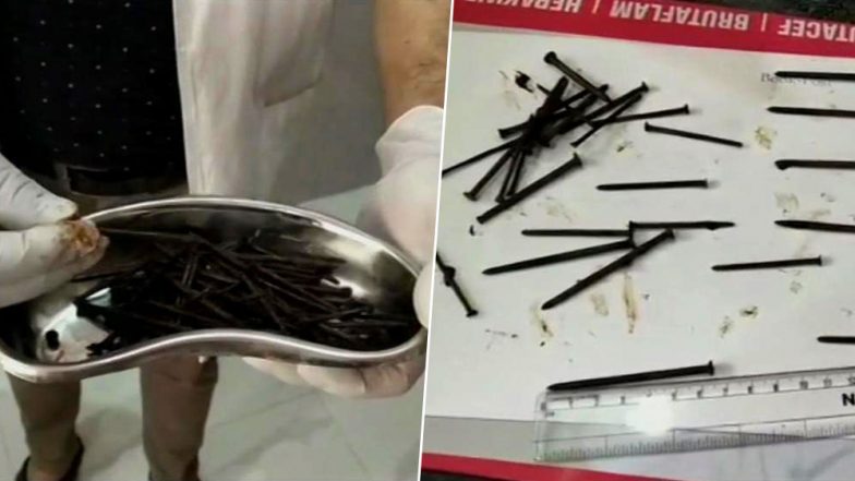 राजस्थान: व्यक्ति को लोहा खाने की थी लत, ऑपरेशन के बाद डॉक्टर्स ने पेट से निकाली 116 लोहे की कीलें, छर्रे और तारों का गुच्छा