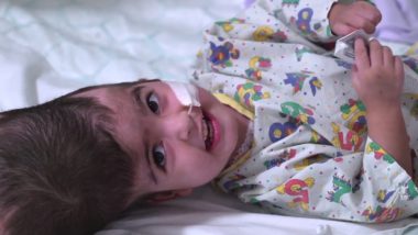 चमत्कार: सिर से जुड़ी दुर्लभ जुड़वां बच्चियों को 55 घंटों की सर्जरी के सफलता पूर्वक किया गया अलग, देखें वीडियो