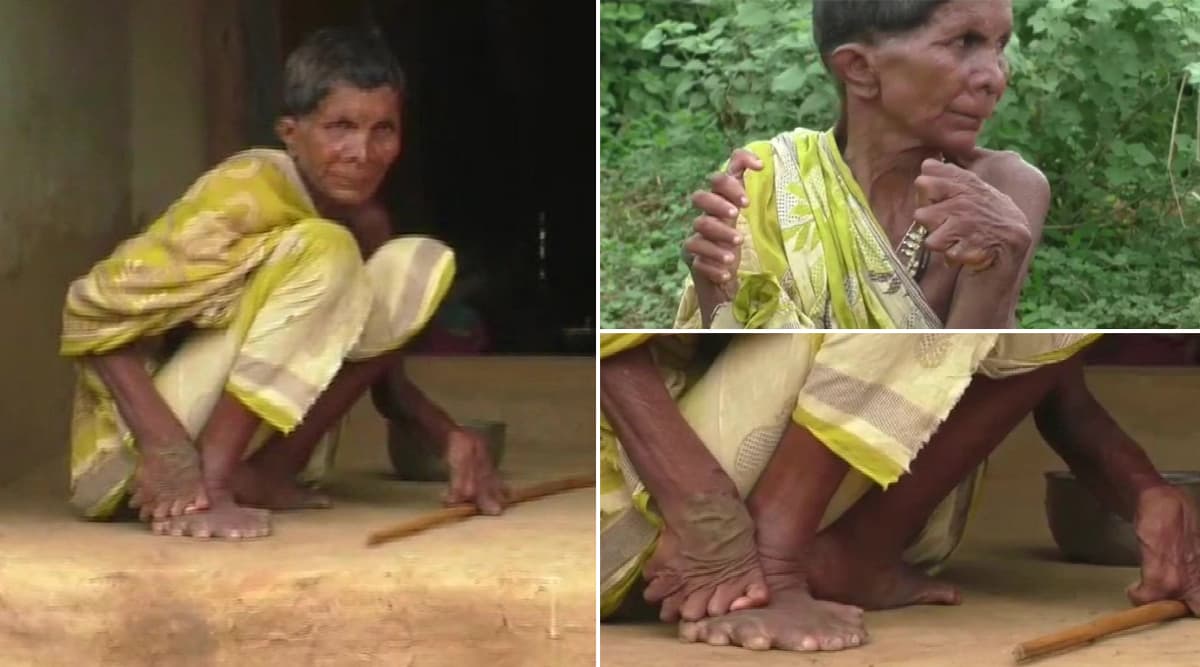 ओडिशा: 20 पैर और 12 हाथ की उंगलियों के साथ जन्मी महिला को लोगों ने बताया चुड़ैल, घर में किया कैद ओडिशा: 20 पैर और 12 हाथ की उंगलियों के साथ जन्मी महिला को लोगों ने बताया चुड़ैल, घर में किया कैद