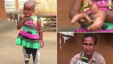 ओडिशा: ये बच्ची अजीब जन्मजात विसंगति से है पीड़ित, हाथ की उंगली पर बढ़ रही हैं 3 और उंगलियां