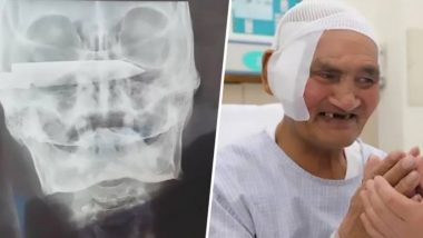 OMG! शख्स के सिर में 26 सालों से फंसा था 4 इंच लंबा चाकू, चीन के डॉक्टरों ने ऐसे निकाला