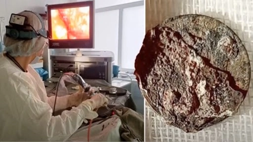 शख्स के दाहिने नथूने से 50 साल बाद निकला सिक्का, देखें हैरान कर देने वाला वीडियो