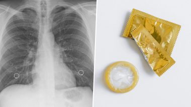 Condom Stuck in Woman's Lung: टीबी से ग्रसित होने की आशंका से महिला पहुंची डॉक्टर के पास, लेकिन सच्चाई जानकर उड़े उसके होश