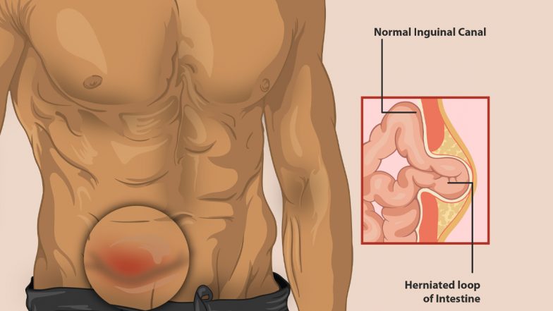 Hernia: हार्निया को हलके से न लें, बस आजमायें ये छ टिप्स, हर्निया से बचे रहेंगे!!