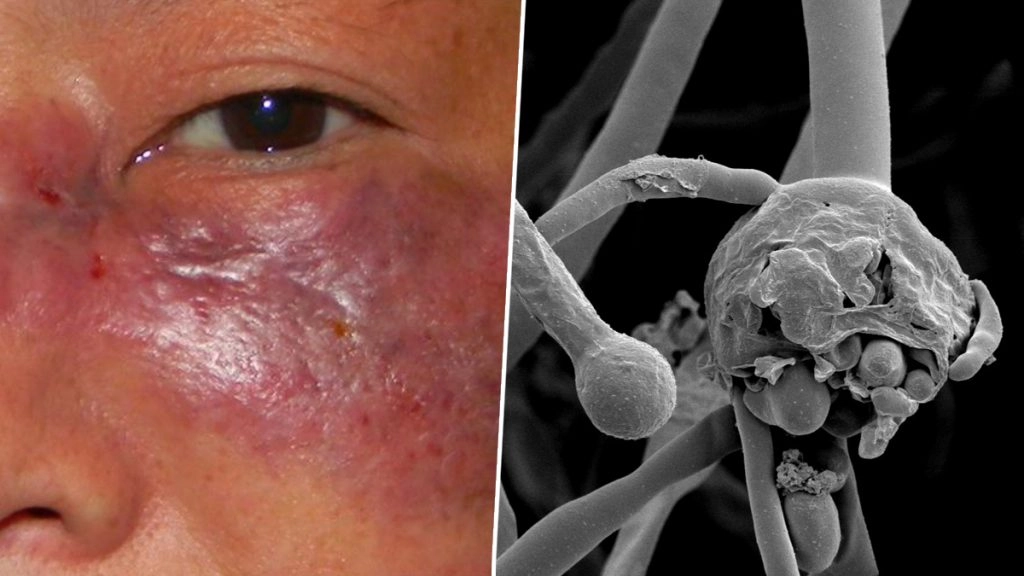 यूपी में ब्लैक फंगस महामारी घोषित