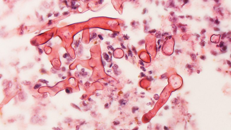 Delhi: दिल्ली में Mucormycosis के कुल 1,734 मामले सामने आए