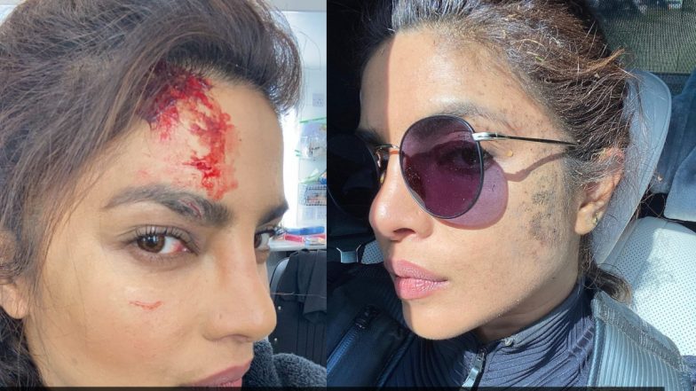शूटिंग के दौरान Priyanka Chopra को लगी चोट, फोटो आई सामने