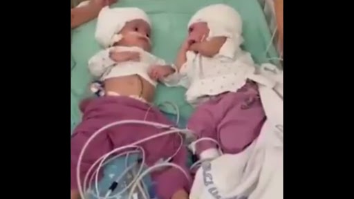 Israel: 12 घंटों की सर्जरी के बाद अलग हुए सिर से जुड़े दुर्लभ जुड़वा बच्चे, अब एक दूसरे को देखने में सक्षम