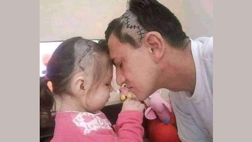 बच्ची की ब्रेन सर्जरी के बाद पिता ने उसकी तरह ही मुंडवाया सिर और बगवाए टांके