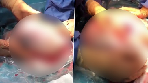 Twin Girl Born Without Breaking Water: ट्विन बेबी गर्ल का एमनियोटिक थैली के साथ हुआ जन्म, दुर्लभ वीडियो हुआ वायरल