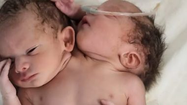 Baby Born With Two Heads: मध्यप्रदेश के रतलाम में दो सिर और तीन हाथ के साथ जन्मा दुर्लभ जुड़वा बच्चा