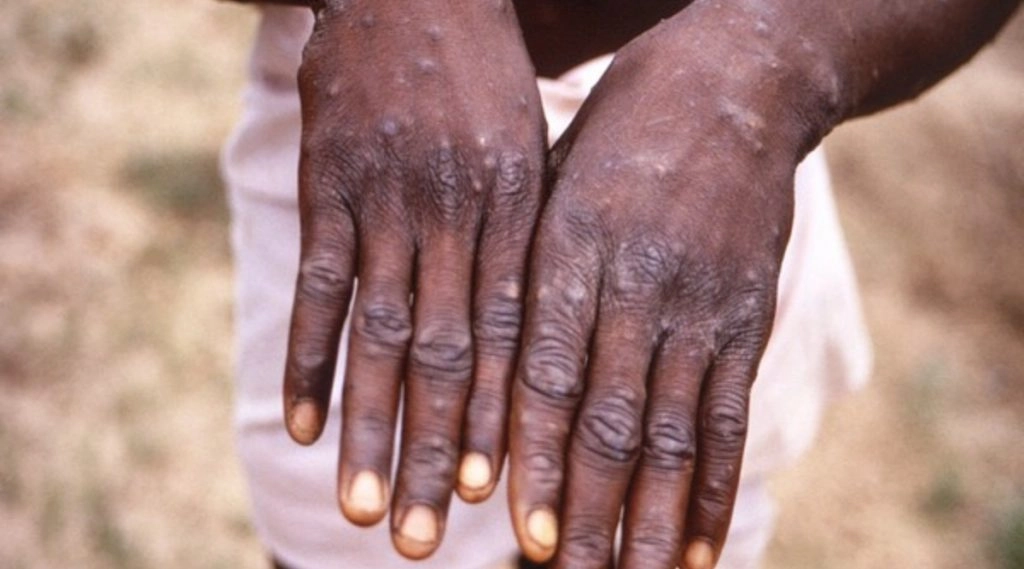 Monkeypox Cases: कनाडा ने 890 मंकीपॉक्स के मामलों की पुष्टि की