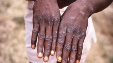 Monkeypox: 11 देशों में फैला मंकीपॉक्स- समझिए क्या है यह वायरस, इसके लक्षण और इलाज