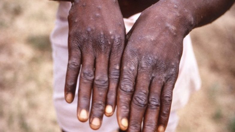 Monkeypox Cases: 12 देशों में मंकीपॉक्स के मामलों की पुष्टि, WHO ने किया खुलासा