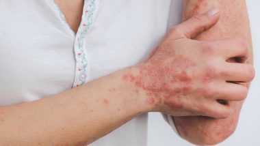 Monkeypox Infection: उत्तराखंड में मंकीपॉक्स को लेकर स्वास्थ्य विभाग ने जारी की एडवाइजरी