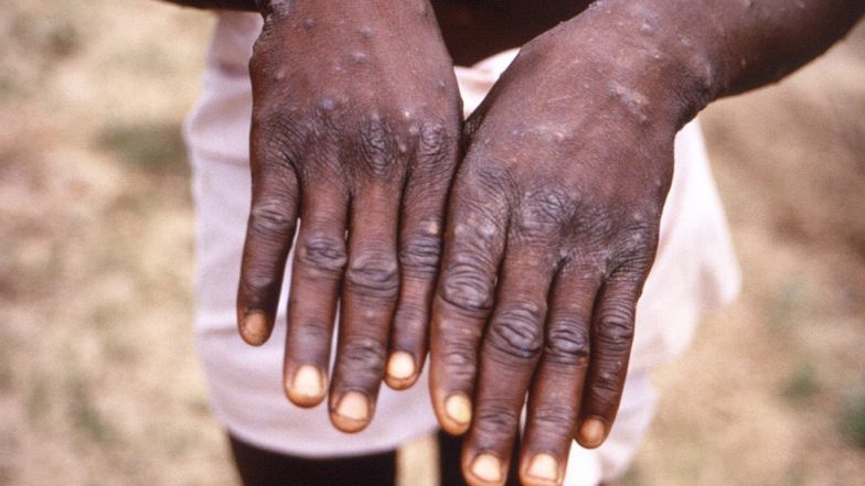 Monkeypox Case: दिल्ली में मंकीपॉक्स का पांचवां मामला आया सामने