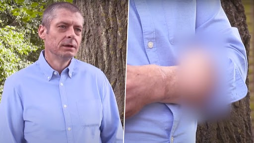 Man With a Penis on His Arm: संक्रमण की वजह से काटनी पड़ी शख्स की पेनिज, डॉक्टरों ने बांह में लगाया नया लिंग, देखें वीडियो
