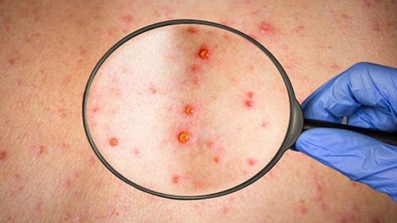दिल्ली में Monkeypox के तीसरे केस की पुष्टि, स्वास्थ्य मंत्री बोले डरने या घबराने की जरूरत नहीं