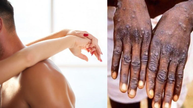 Monkeypox Cases: बढ़ते मंकीपॉक्स के मामलों को लेकर कर्नाटक ने केरल सीमा पर चौकसी बढ़ाई