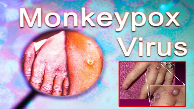 Monkeypox In Delhi: दिल्ली में मिला मंकीपॉक्स का पहला केस, विशेषज्ञों ने कहा- सतर्क रहें, घबराएं नहीं