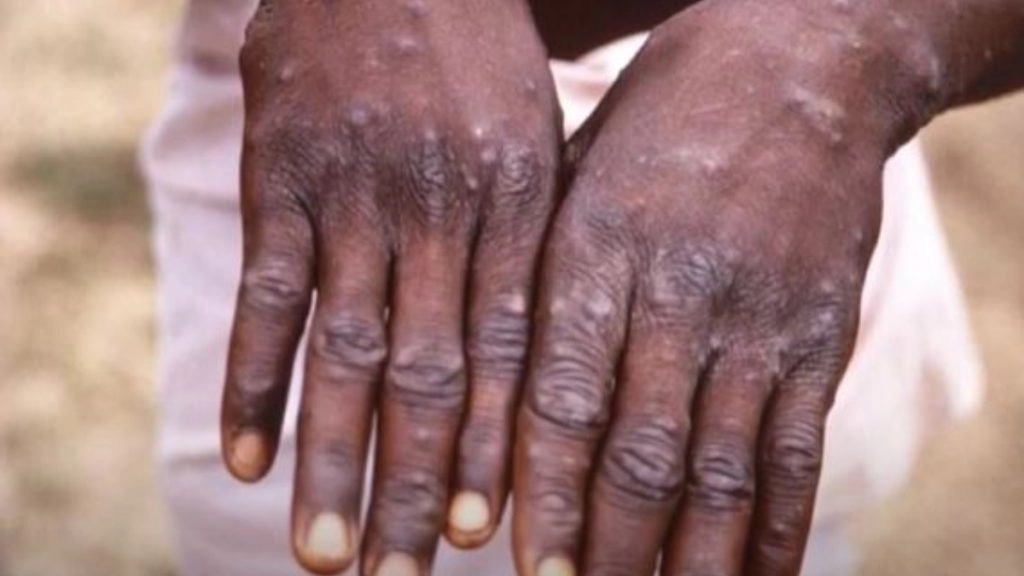 आईसीएमआर ने मंकीपॉक्स रोगियों के संपर्क में आए लोगों के बीच सीरो-सर्वेक्षण की योजना बनाई