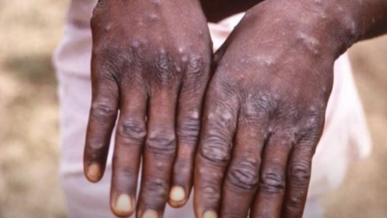 Monkeypox Case: एक और मंकी वायरस मानव के लिए हो सकता है घातक