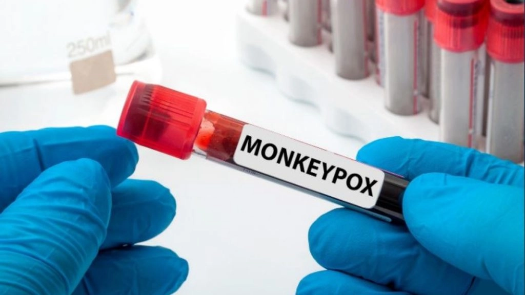 दिल्ली में Monkeypox का एक और केस, नाइजीरियन महिला संक्रमित
