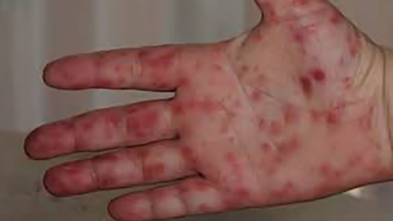 Tomato Flu से हो जाएं सावधान, SARS-CoV-2, मंकीपॉक्स, डेंगू, चिकनगुनिया से संबंधित नहीं है वायरस- केंद्र ने जारी की एडवाइजरी