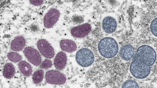 Italy: स्पेन से लौटने के बाद शख्स एक ही समय में Monkeypox, COVID-19  और HIV पॉजिटिव पाया गया