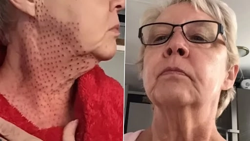 स्किन टाईटनिंग ट्रीटमेंट कराना महिला को पड़ा महंगा, गर्दन हुई छिपकली जैसी 