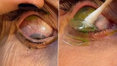 Shocking! दर्द की शिकायत के बाद अमेरिकी डॉक्टर ने महिला की आंख से निकाले 23 कॉन्टैक्ट लेंस, देखें वायरल वीडियो