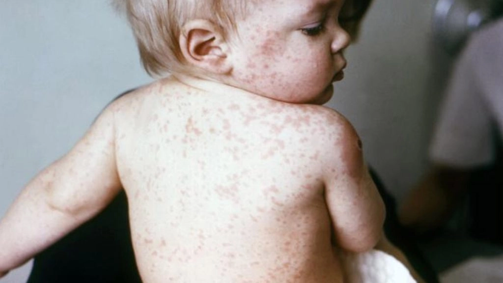 Measles Outbreak in Mumbai: बच्चे की मौत, इस साल 126 बच्चे संक्रमित