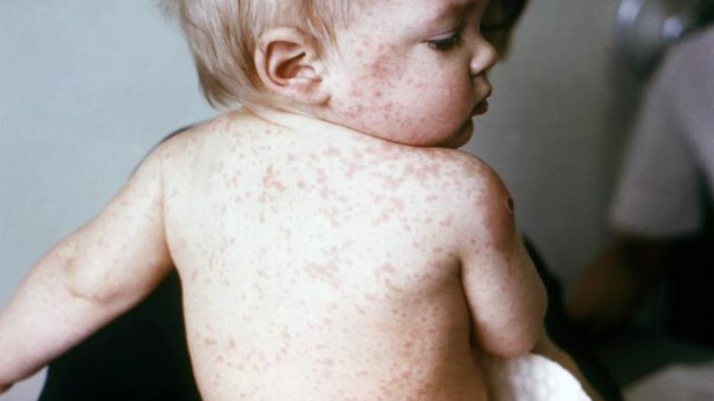 Measles Outbreak in UP: यूपी के गांव में खसरे का प्रकोप, तीन बच्चों की मौत