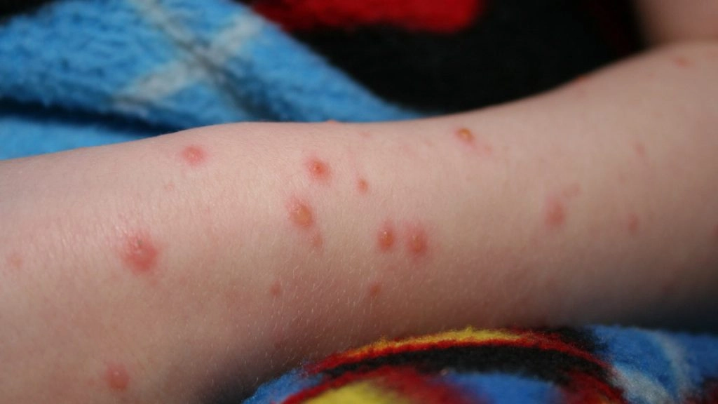 मुंबई में कोरोना के बाद खसरे का खतरा बढ़ा, बीते 24 घंटे में पाए गए 23 मरीज, अब तक 15 की मौत