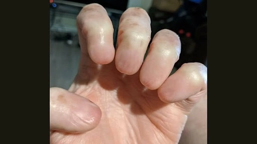Shocking! शख्स के हाथ में नाखून गायब होने की तस्वीर वायरल, इंटरनेट पर लोग हैरान