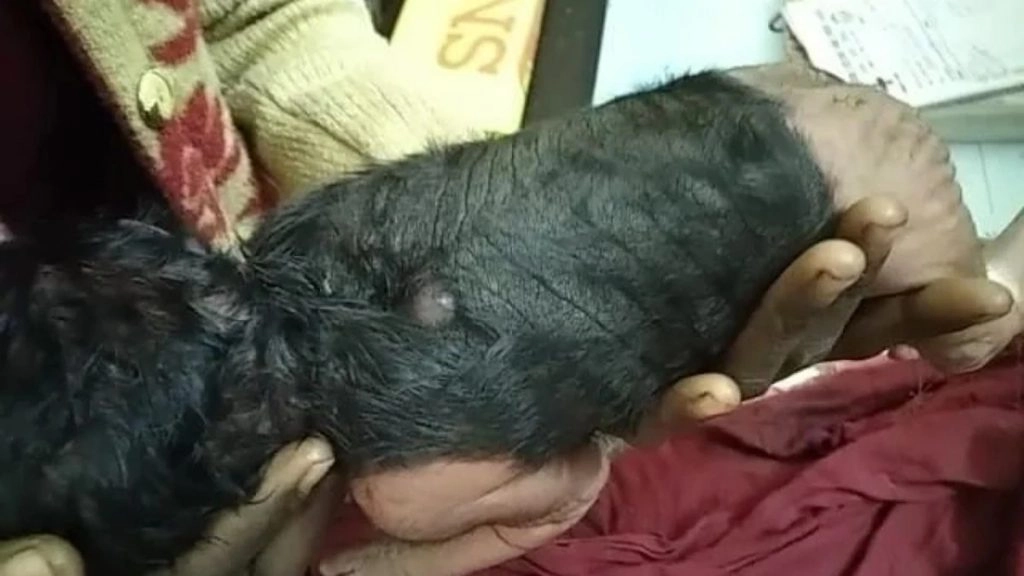 UP: काले धब्बे और पीठ पर घने बालों के साथ जन्मा बच्चा