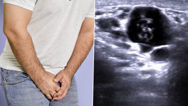 Worms in Testicles! टेस्टिकल्स में आई सूजन तो शख्स ने कराई जांच, प्राइवेट पार्ट में कीड़े देख उड़े होश (Watch Video)