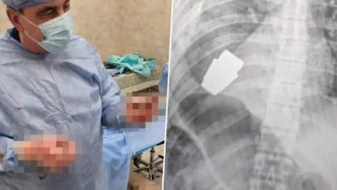 Live Bomb Inside Body: यूक्रेनी सैनिक की बॉडी में मिला जिंदा बम, बिना फटे ग्रेनेड को निकालने के लिए सर्जन ने किया ऑपरेशन (See Pic)