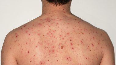 Chickenpox: यूपी के बलिया में 20 स्कूली बच्चे, एक शिक्षक चिकनपॉक्स से संक्रमित