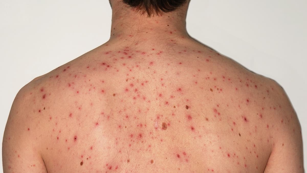 Chickenpox: यूपी के बलिया में 20 स्कूली बच्चे, एक शिक्षक चिकनपॉक्स से संक्रमित