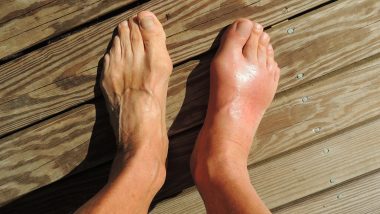 Swollen Feet: पैरों में सूजन किडनी की समस्या का हो सकता है संकेत, लापरवाही पड़ सकती है भारी!