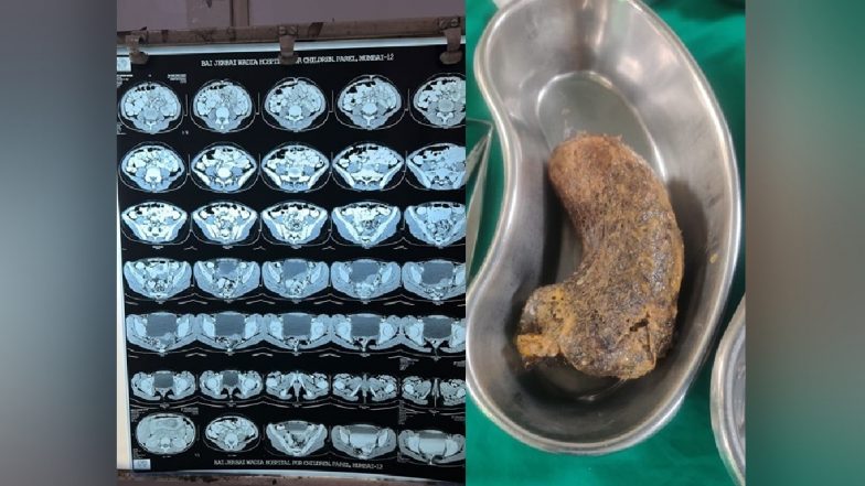 Hair in Stomach: डॉक्टरों ने बच्ची के पेट से निकाला 100 ग्राम 'बालों का गुच्छा', अजीब बीमारी से पीड़ित है मासूम