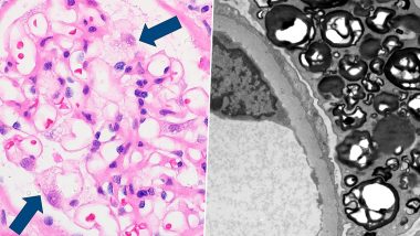 Fabry disease: पैरोकार समूह ने स्वास्थ्य मंत्रालय से हस्तक्षेप का किया अनुरोध