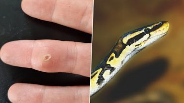 Snake Tooth Lodged in Finger: शख्स की उंगली में फंसा सांप का दांत, दर्द होने पर एक साल बात पता चला (See Pics)
