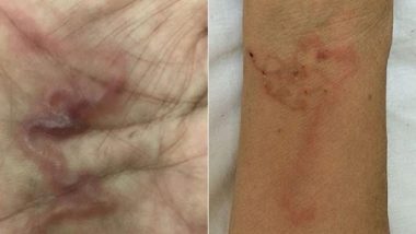 Parasites Found Under Woman's Skin: कच्चे खून का हलवा खाने के बाद वियतनाम की महिला की त्वचा के नीचे चलते दिखे परजीवी