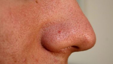 Skin Cancer: महिला की नाक का दर्दनाक पिंपल निकला घातक कैंसर, जानें Basal Cell Carcinoma के लक्षण